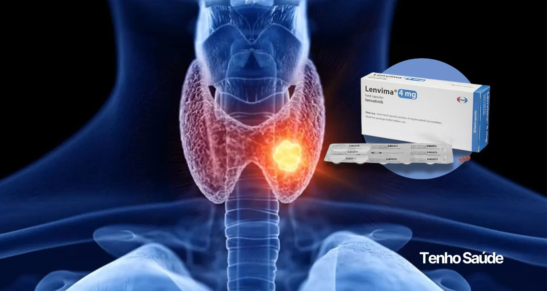 Thyroid Cancer: health plans must include new treatment with Lenvatinib Mesylate (Lenvima). - Tenho Saúde Thyroid Cancer health plans must include new treatment with Lenvatinib Mesylate (Lenvima). I Have Health