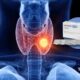 Cáncer de Tiroides: los planes de salud deben incluir un nuevo tratamiento con Lenvatinib Mesilato (Lenvima). - Estoy sano Los planes de salud para el cáncer de tiroides deben incluir un nuevo tratamiento con lenvatinib mesilato (Lenvima). estoy sano