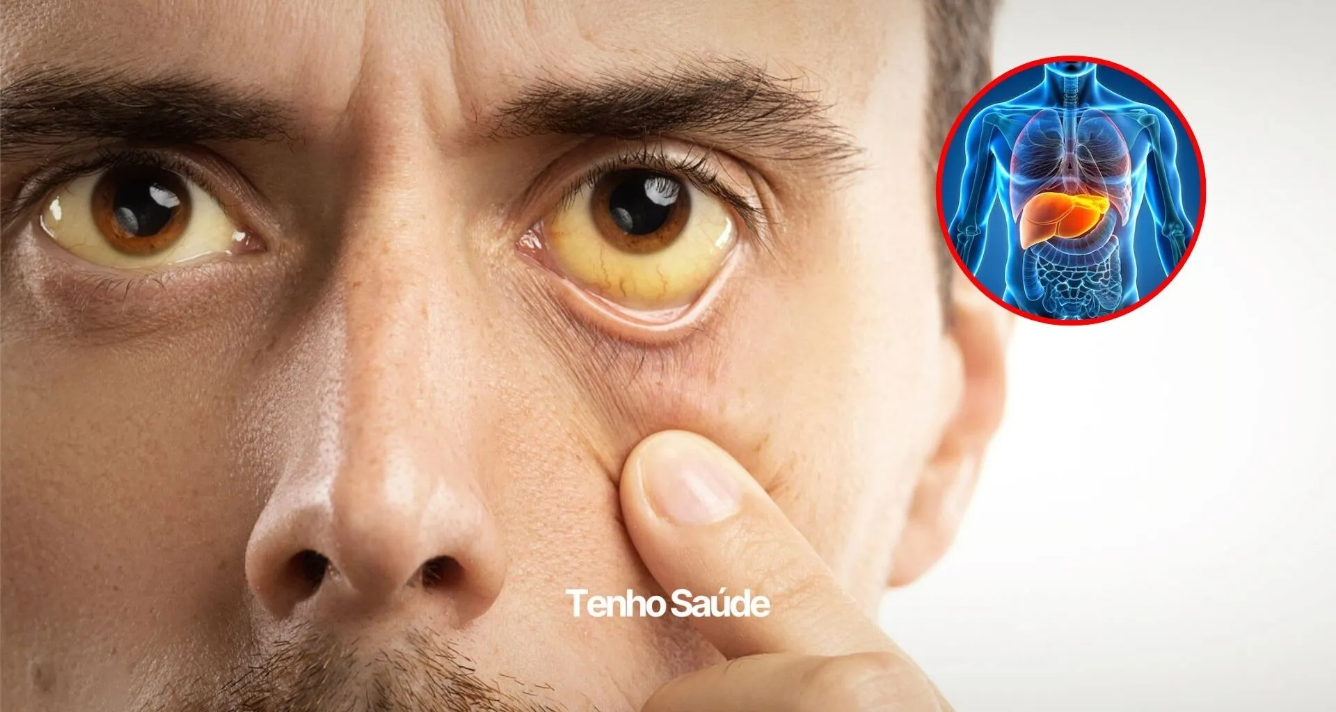 5 signos tempranos de problemas hepáticos - Estoy Saludable 5 signos tempranos de problemas hepáticos - Estoy Saludable