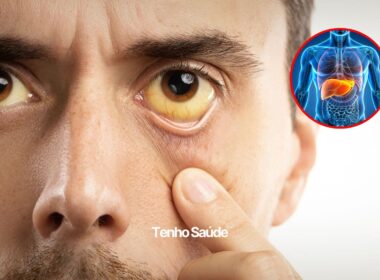 5 sinais iniciais de problemas no fígado - Tenho Saúde 5 sinais iniciais de problemas no fígado - Tenho Saúde