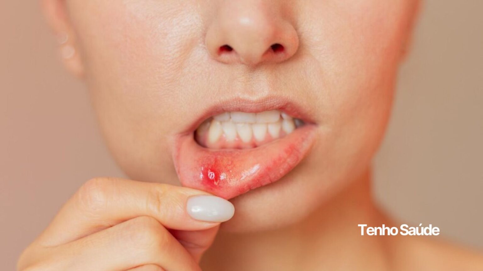 Acabe com a Afta: tratamentos caseiros, remédios e o que comer e evitar ...