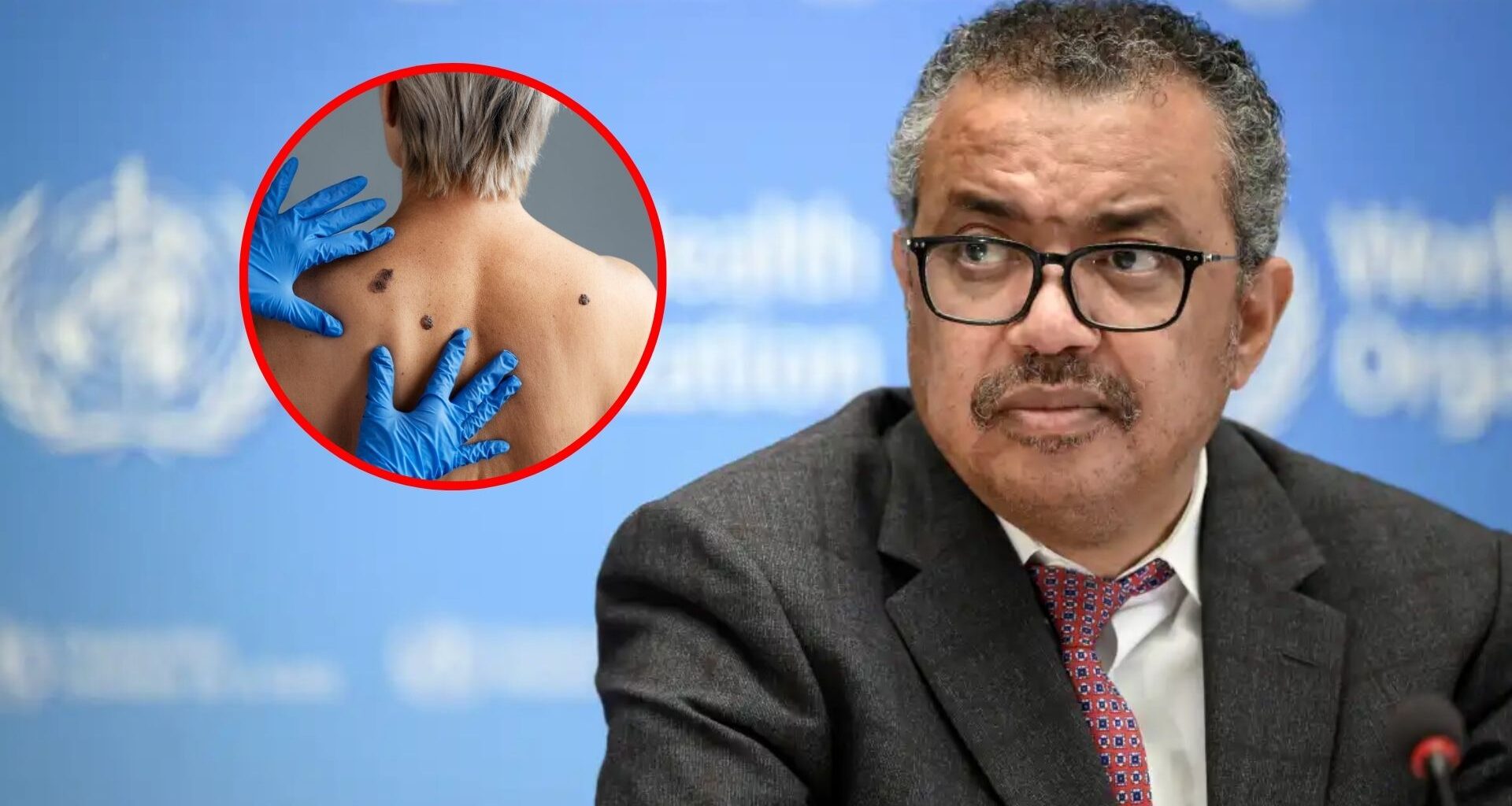 Mpox: OMS eleva alerta internacional al nivel máximo - Tem Saúde Mpox OMS eleva alerta internacional al nivel máximo - Tem Saúde