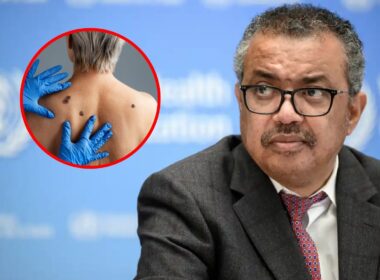 Mpox: OMS eleva alerta internacional ao nível máximo - Tenho Saúde Mpox OMS eleva alerta internacional ao nível máximo - Tenho Saúde