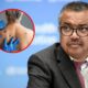 Mpox: OMS eleva alerta internacional al nivel máximo - Tem Saúde Mpox OMS eleva alerta internacional a nivel máximo